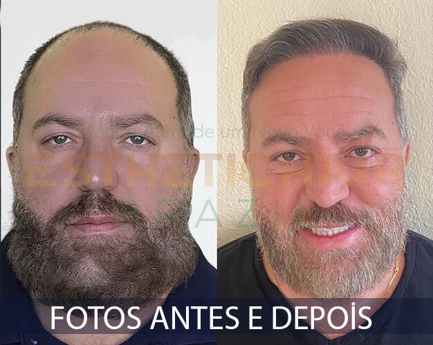 FOTOS ANTES E DEPOIS