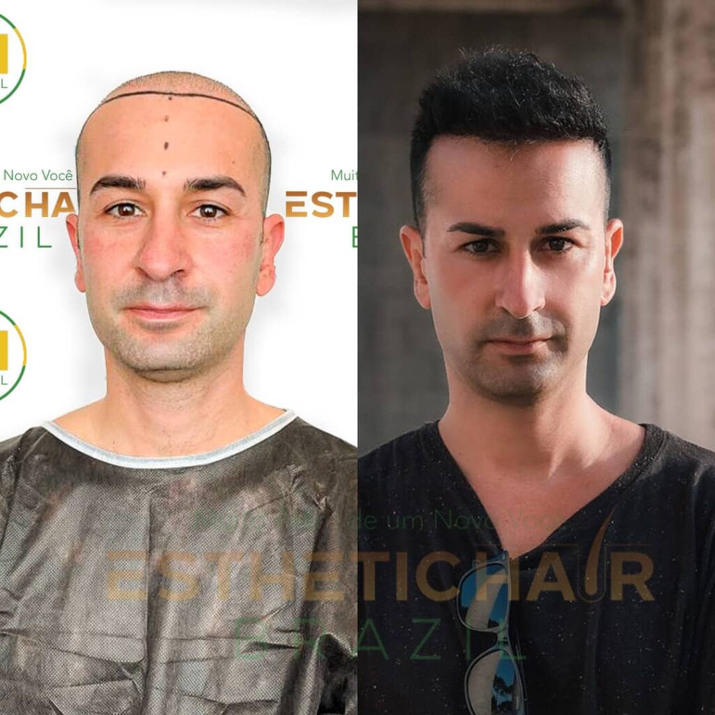 esthetic hair brazil antes e depois transplante capilar