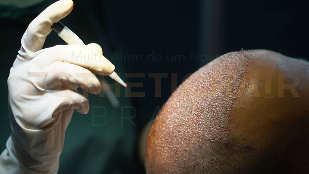 dhi hair transplantation