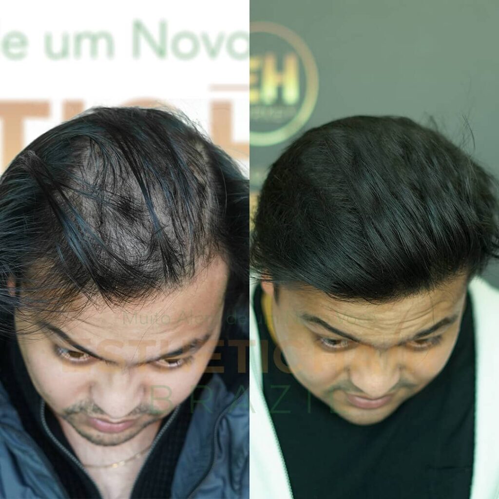 esthetic hair brazil implante capilar antes e depois