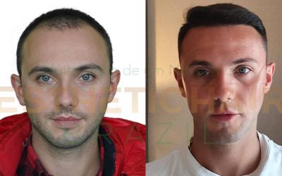 esthetic-hair-brazil-antes-e-depois-das-fotos-1